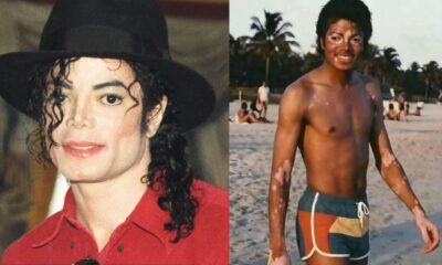 Michael Jackson vitiligo