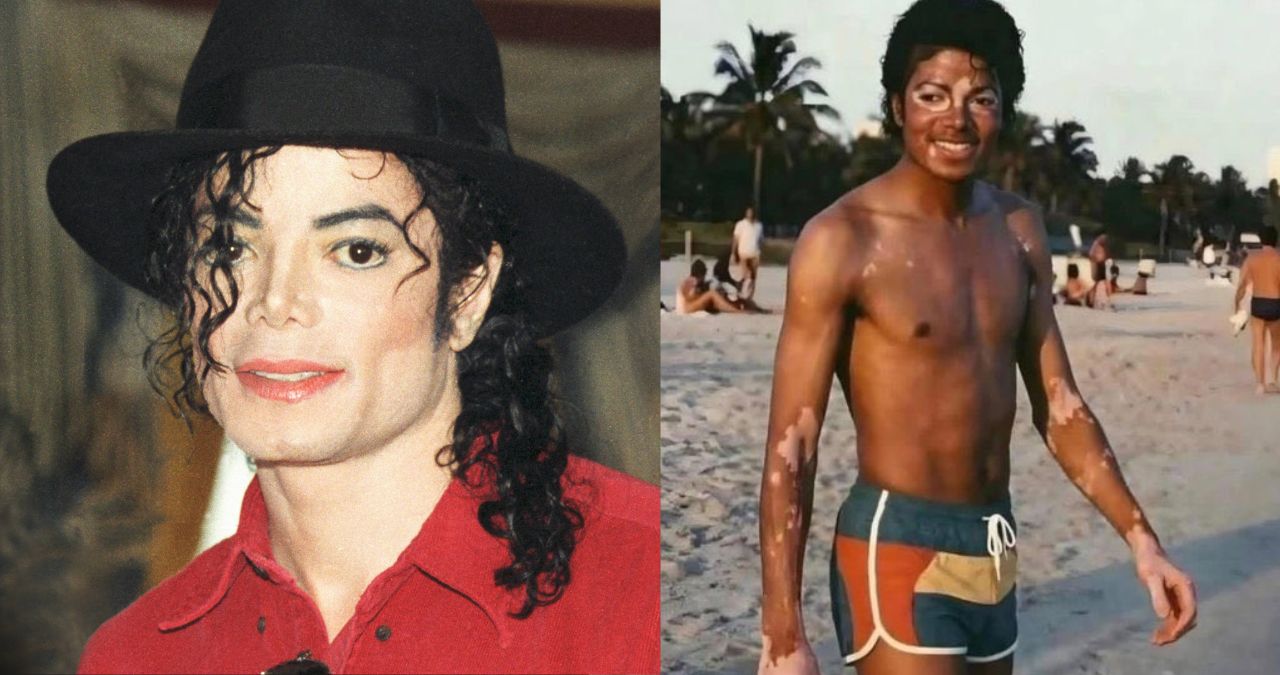 Michael Jackson vitiligo